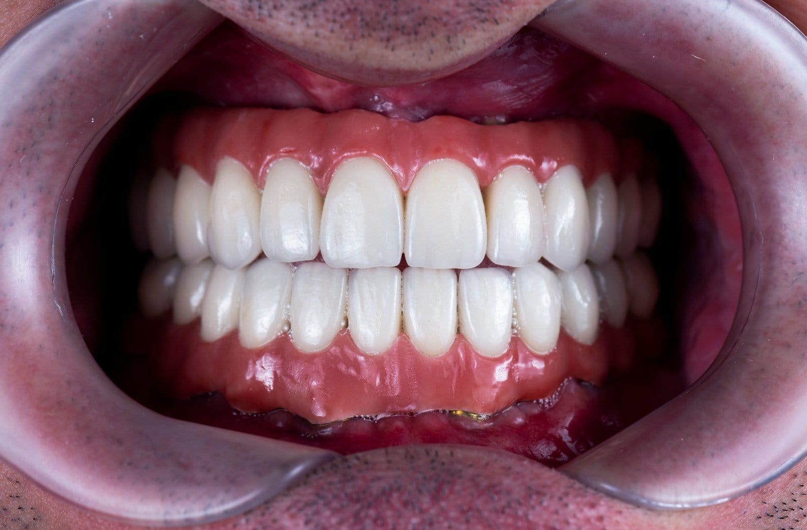 Dinti ficsi pe implanturi dentare