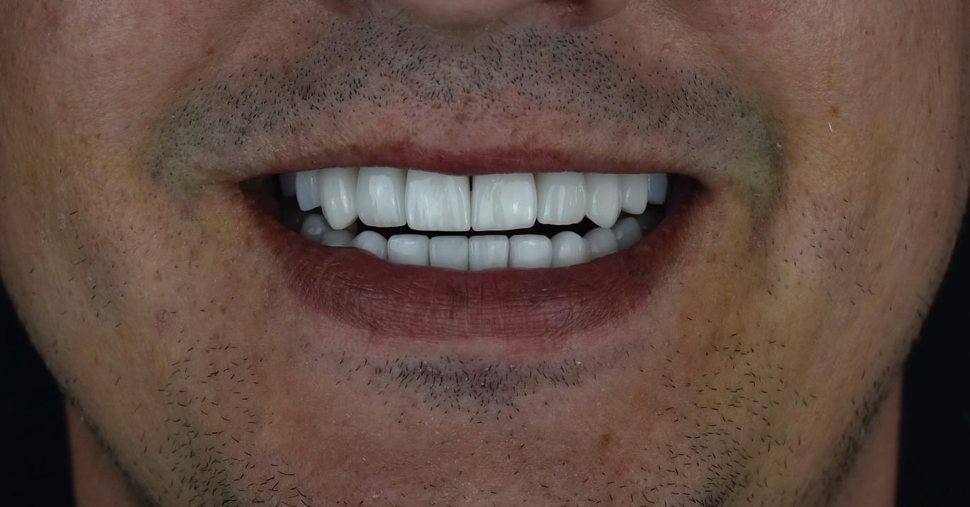 Fatete dentare after
