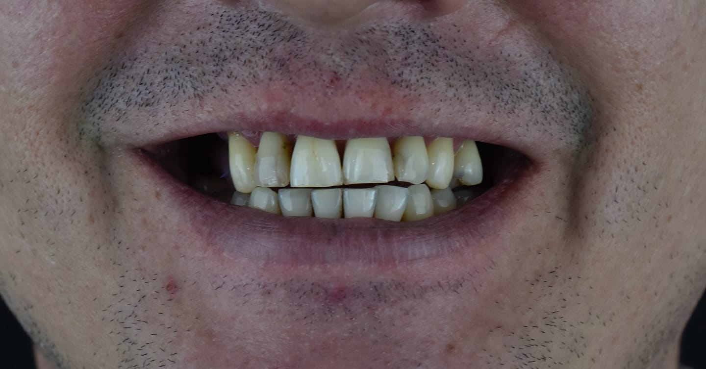 Fatete dentare before