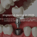 totul despre implantul dentar