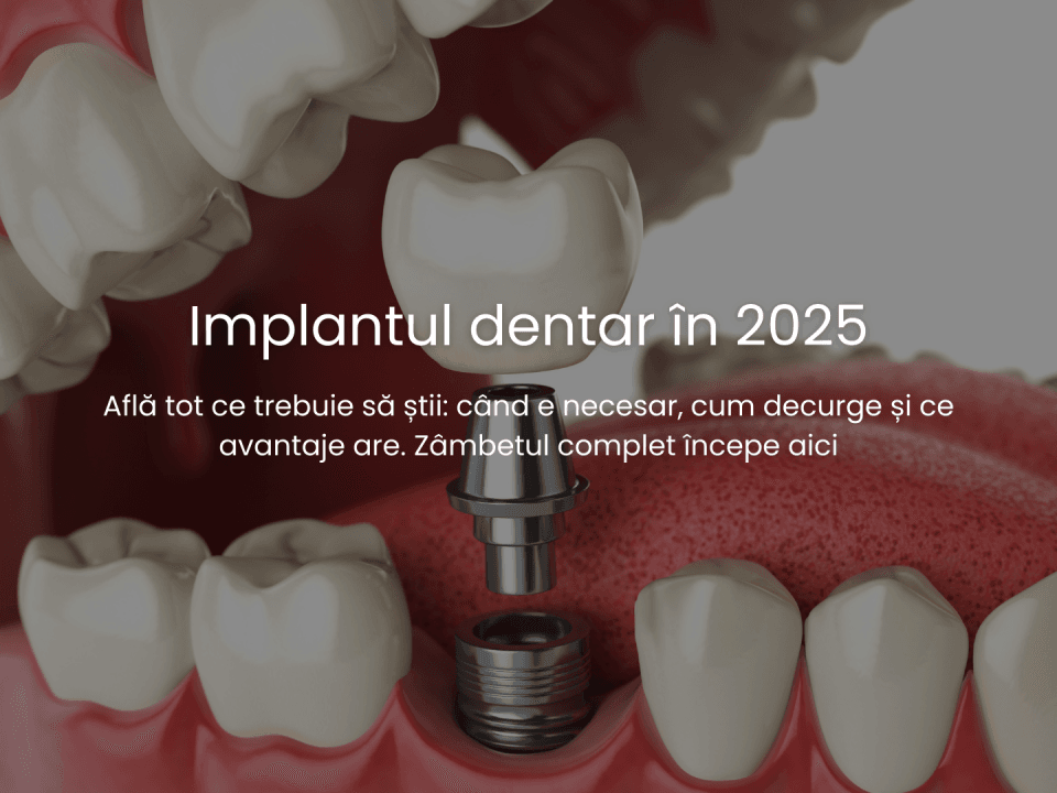 totul despre implantul dentar