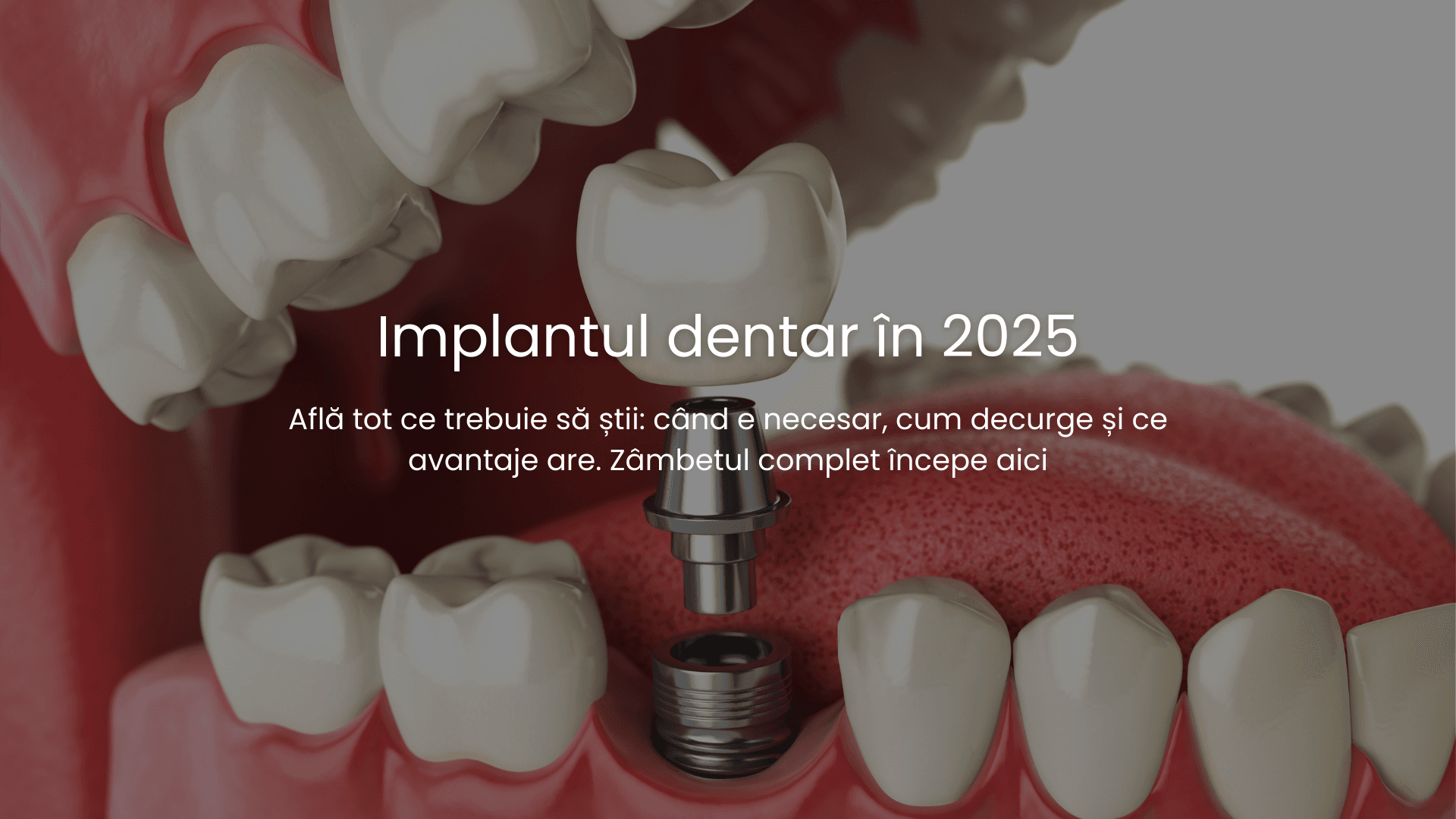 totul despre implantul dentar