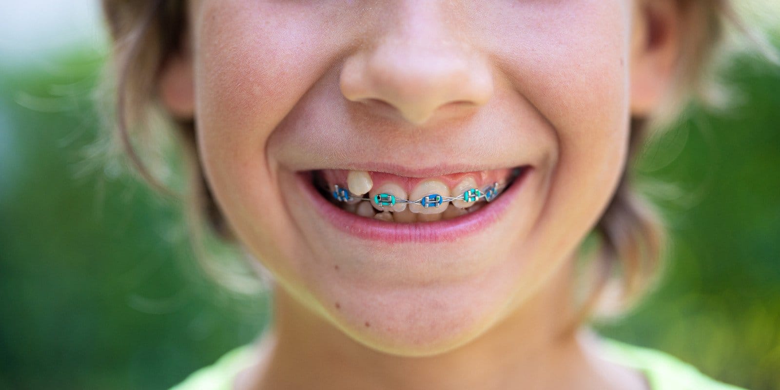 Aparat dentar copii